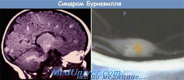 синдром Бурневилля