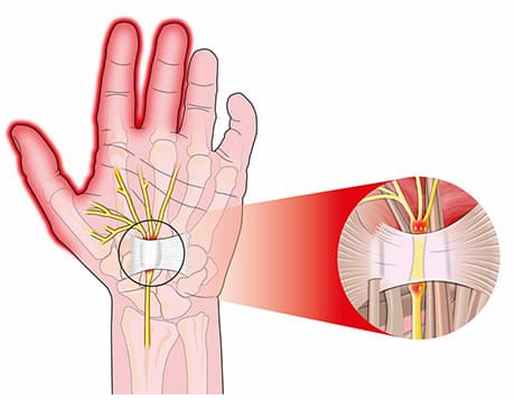 Туннельные нейропатии. Лечение туннельных нейропатий - изображение 2