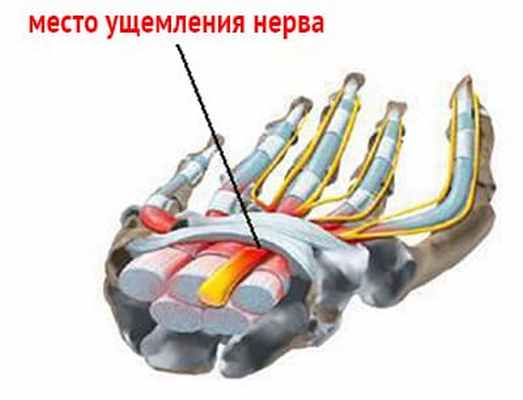 Туннельные нейропатии. Лечение туннельных нейропатий - изображение 1
