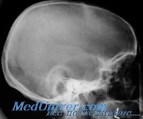 турецкое седло при опухоли