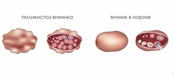 Поликистоз яичников 2.jpg