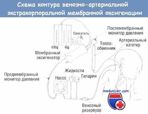Схема контура экстракорпоральной мембранной оксигенации (ЭКМО)