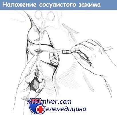 Наложение сосудистого зажима