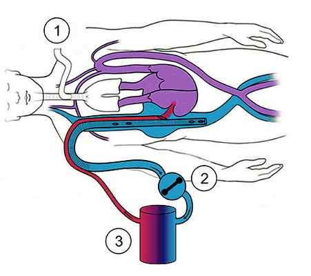 Экстракорпоральная мембранная оксигенация