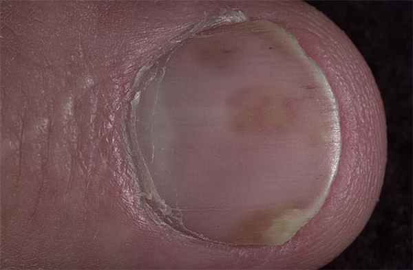 Пятна на ногте при начальной стадии псориаза