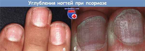 Углубления ногтей при псориазе