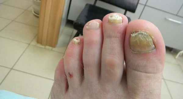 Псориаз на ногтях ног