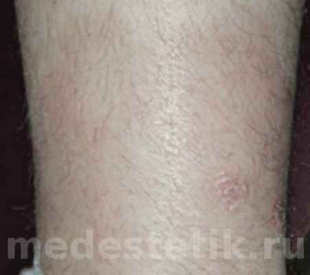 Врач-дерматовенеролог Сергеев Юрий Юрьевич