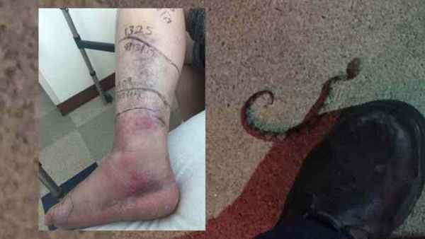 последствия от укуса щитомордника