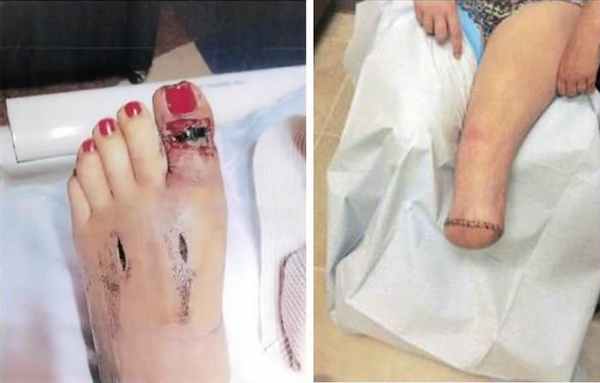 последствия укуса водяного щитомордника