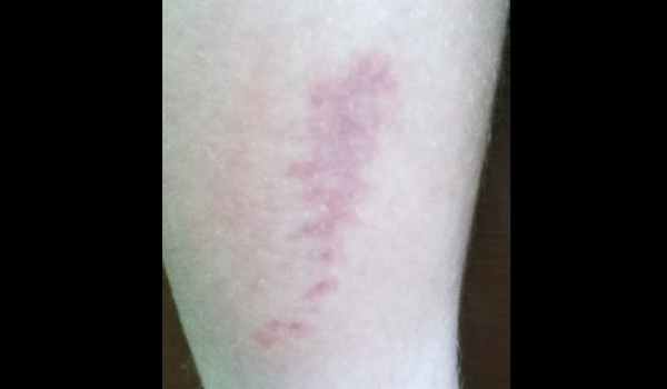 сыпь от волосков