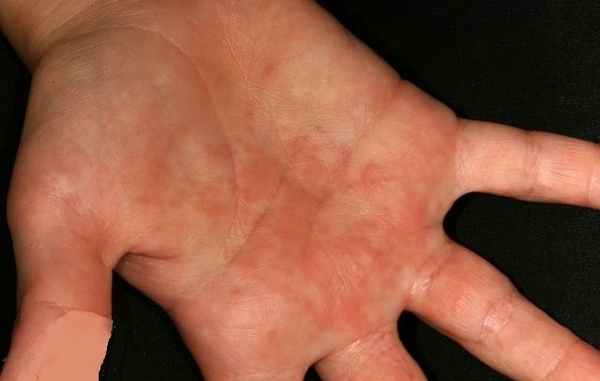 кожная реакция