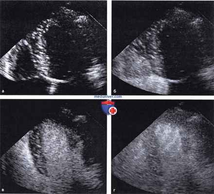 Ультразвуковые контрастные средства
