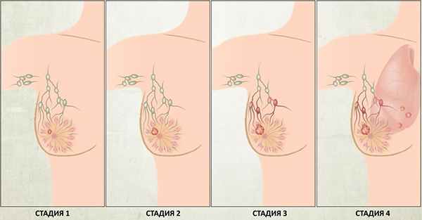 Диагностика рака молочной железы