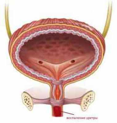 уретрит