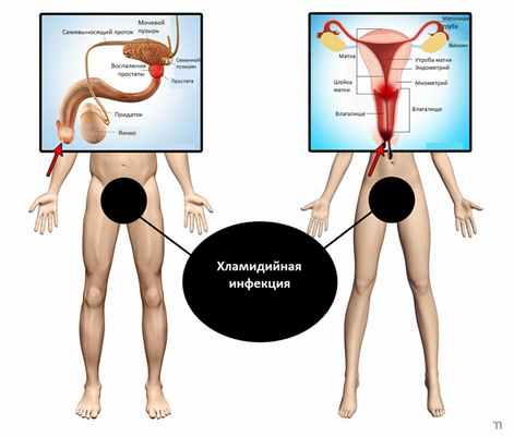 хламидиоз у женщин и мужчин.jpg