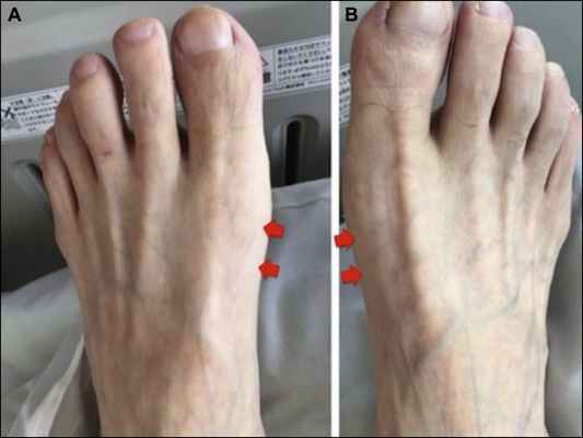 Молоткообразная деформация пальцев