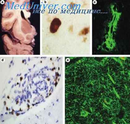 ушиб продолговатого мозга
