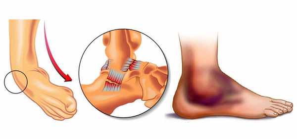 повреждение сухожилий при вывихе