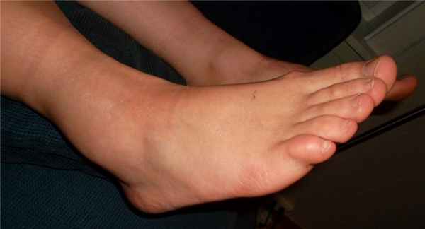 отек при вывихе стопы