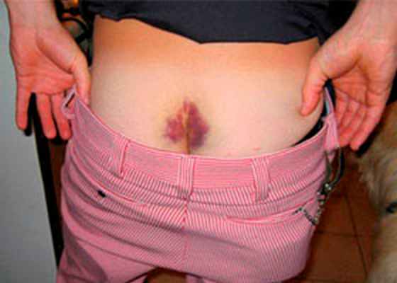 Ушиб и перелом копчика