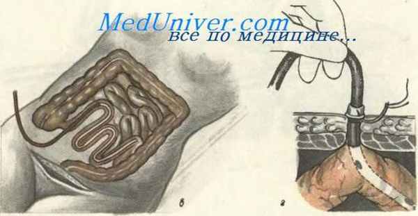 Кишечный свищ (энтеростомия)