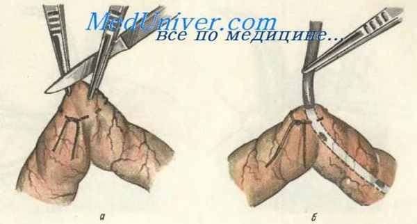 Кишечный свищ (энтеростомия)