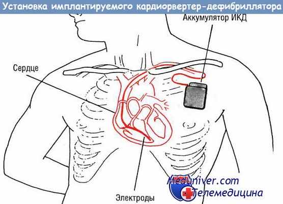 Установка имплантируемого кардиовертер-дефибриллятора (ИКД)