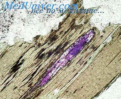 криминальный аборт