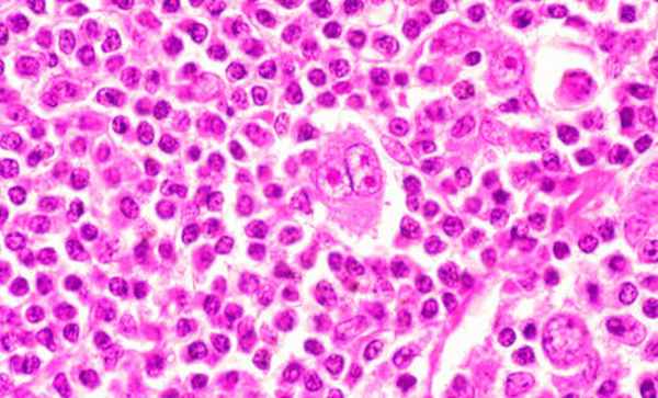 Причины развития неходжкинских лимфом