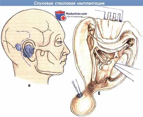 Слуховая стволовая имплантация
