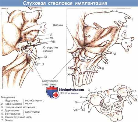 Слуховая стволовая имплантация
