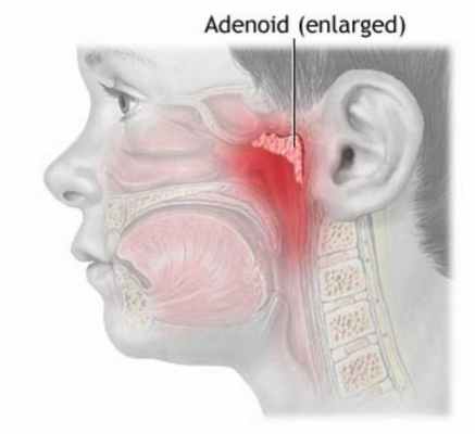 аденоиды у ребенка