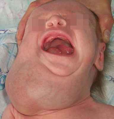 лимфатическая мальформация шеи