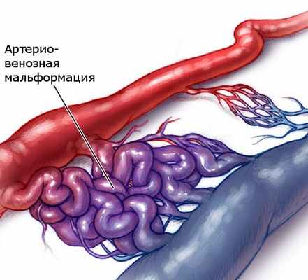 Расширение связей между артерией и веной приводит к развитию мальформации