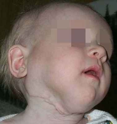 лимфатическая мальформация шеи сбоку после лечения