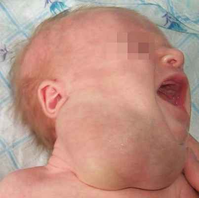 лимфатическая мальформация шеи сбоку