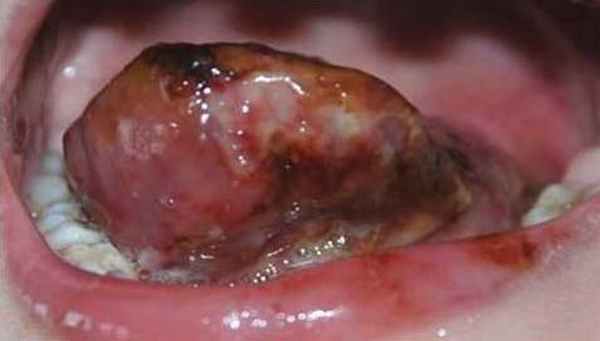 лечение мальформация