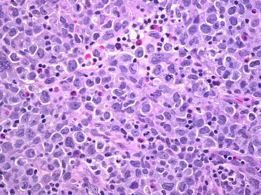 лечение лимфомы за рубежом