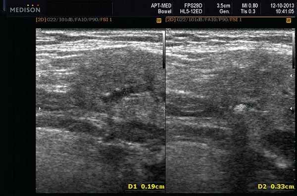 Эхограмма - камень в протоке поднижнечелюстной слюнной железы
