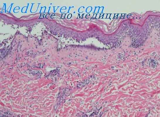 чешуйчатый лишай