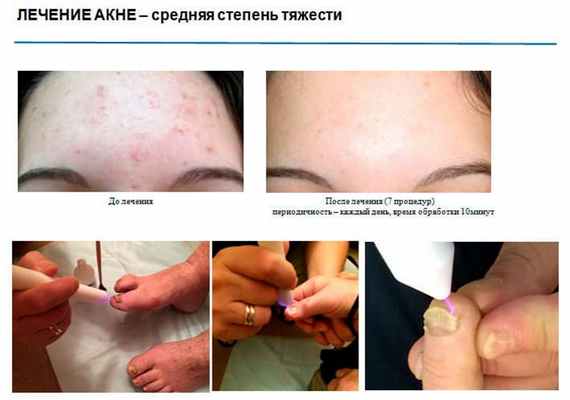 Лечение Акне