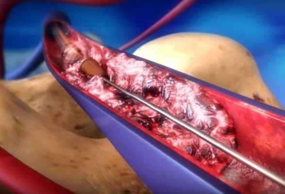 Ангиоджет - эффективный метод удаления венозных тромбов