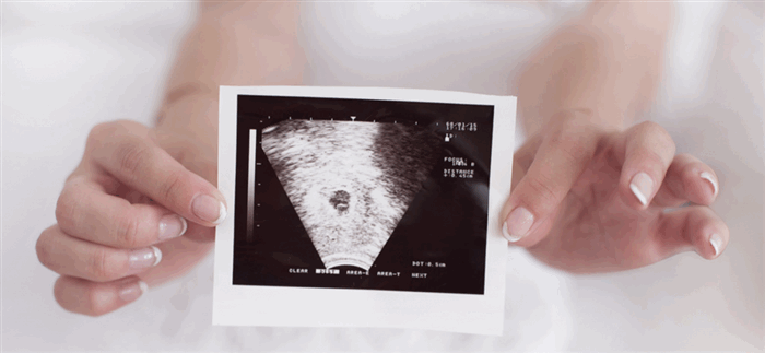 Эндометриоз