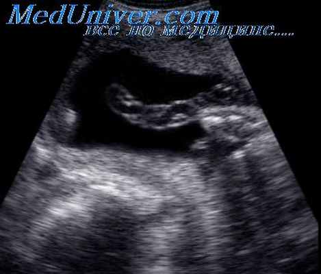 узлы пуповины