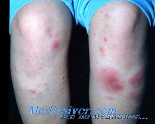 узловатая эритема