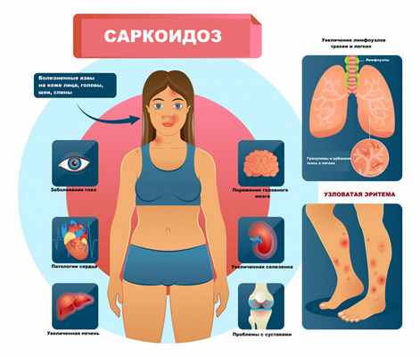 Саркоидоз.jpg