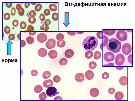 B12 анемия