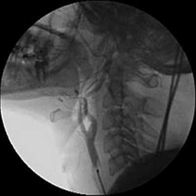 Ангиография дуги аорты и брахиоцефальных артерий