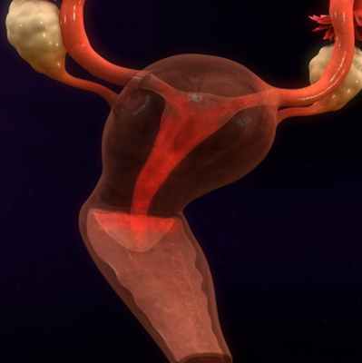 Маточное кровотечение